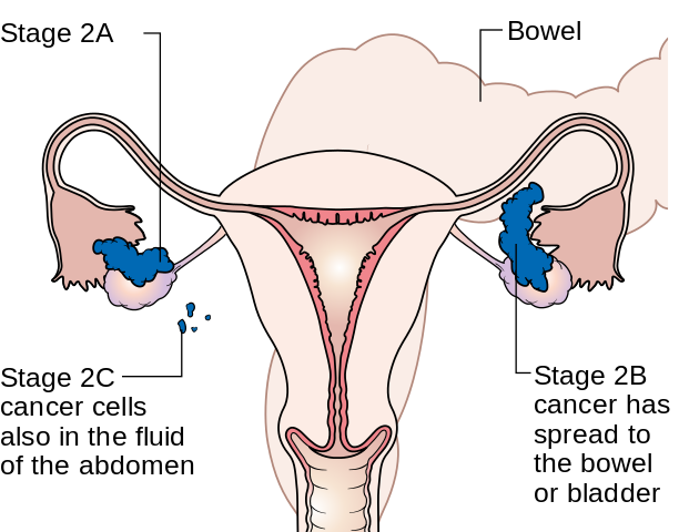 Ovarian cancer